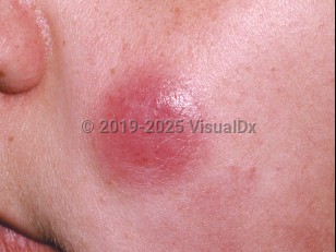 Clinical image of Adult T-cell leukemia/lymphoma - imageId=193856. Click to open in gallery.  caption: 'A pink nodule on the cheek.'