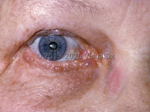 Clinical image of Apocrine hidrocystoma - imageId=194172. Click to open in gallery.  caption: 'Numerous small, translucent cystic papules on the upper and lower eyelid margins.'