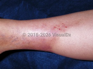 Clinical image of Panniculitis - imageId=199728. Click to open in gallery.  caption: 'A depressed light brown and violaceous plaque of the lower leg, imparting a champagne-bottle-like appearance to the leg.'