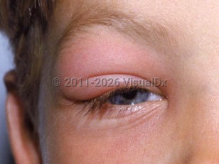 Honeybee sting