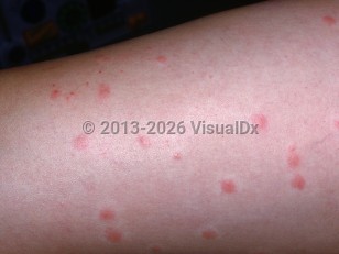 Cercarial dermatitis