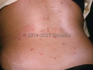 Clinical image of Mite dermatitis - imageId=2035118. Click to open in gallery.  caption: 'Numerous reddish and brown papules, some in linear arrays, on the back.'