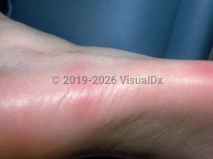 Clinical image of Palmar-plantar eccrine hidradenitis - imageId=2036064. Click to open in gallery.  caption: 'Erythematous plaques on the sole.'