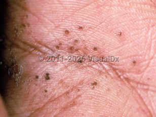 Clinical image of Porokeratotic eccrine ostial and dermal duct nevus - imageId=2036788. Click to open in gallery.  caption: 'Numerous keratotic pits of various sizes, some with a brown hue, on the palm.'