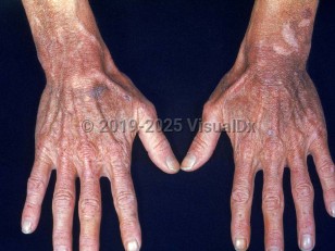 Clinical image of Pellagra - imageId=2057827. Click to open in gallery. 