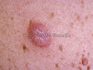 Clinical image of Pseudolymphoma - imageId=209984. Click to open in gallery.  caption: 'A close-up of a reddish nodule that was rubbery on palpation (with surrounding tiny seborrheic keratoses and a pink pedunculated nevus).'