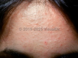 Clinical image of Acne vulgaris - imageId=2106161. Click to open in gallery.  caption: 'Multiple open and closed comedones and a few excoriated papules on the forehead.'