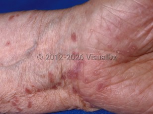 Lichen planus