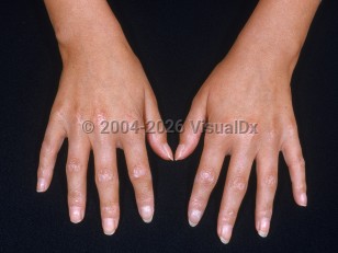 Clinical image of Scleroderma of childhood - imageId=2135108. Click to open in gallery.  caption: 'Sclerodactyly and atrophic white papules over some knuckles.'