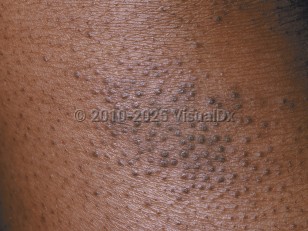 Clinical image of Atopic dermatitis - imageId=214627. Click to open in gallery.  caption: 'A close-up of follicular papules with scale.'
