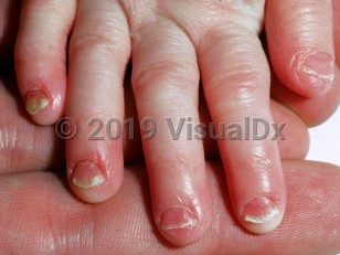 Clinical image of Trichothiodystrophy - imageId=2153102. Click to open in gallery.  caption: 'Short, broad fingernails with distal thickening.'