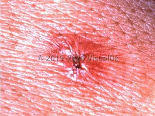 Clinical image of Japanese spotted fever - imageId=2183681. Click to open in gallery.  caption: 'A close-up of an erythematous papule with a central hemorrhagic crust.'