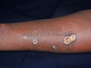 Clinical image of Skin popping substance abuse - imageId=2193412. Click to open in gallery.  caption: 'Crusted papules and ulcers on the arm.'