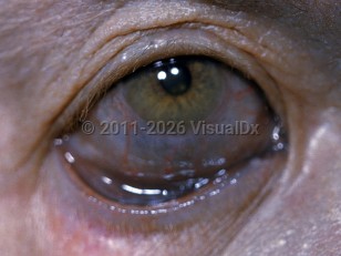 Clinical image of Argyria - imageId=2193996. Click to open in gallery.  caption: 'Blue-gray discoloration of the sclera and periorbital skin after use of a topical silver-containing antiseptic.'