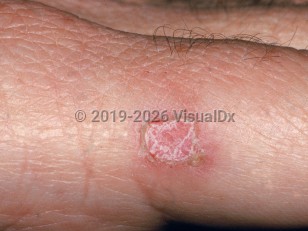 Clinical image of Iododerma - imageId=2199226. Click to open in gallery.  caption: 'A scaly and crusted pink papule on the finger, developing after administration of iodides.'