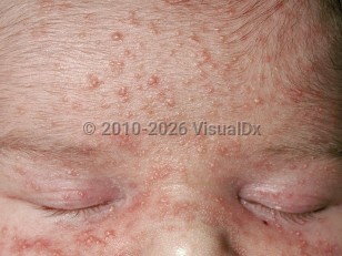 Clinical image of Neonatal acne - imageId=221053. Click to open in gallery.  caption: 'Multiple tiny pustules and papules and a few interspersed closed comedones, on a background of erythema on the central face.'