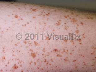 Clinical image of Capillaritis - imageId=221951. Click to open in gallery.  caption: 'Multiple tiny, cayenne pepper-type petechiae and golden-brown macules on the thigh.'