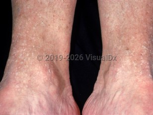 Clinical image of Acrokeratosis verruciformis - imageId=2225855. Click to open in gallery.  caption: 'Numerous discrete, hypopigmented, scaly papules around the ankles.'