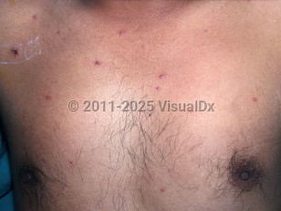 Clinical image of Talaromyces marneffei infection - imageId=2237809. Click to open in gallery.  caption: 'Numerous erythematous papules, some umbilicated, scattered on the chest of a patient with HIV.'