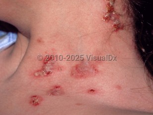 Clinical image of Pemphigus vegetans - imageId=223843. Click to open in gallery.  caption: 'Flaccid vesicles, some cloudy, with surrounding erosions and crusting, on the lateral neck.'