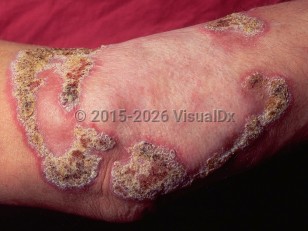 Clinical image of Blastomycosis - imageId=227995. Click to open in gallery.  caption: 'A patterned, thickly scaly and crusted plaque with central atrophy and erythematous borders, on the arm.'