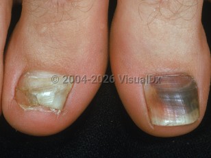 Clinical image of Subungual hematoma - imageId=2292687. Click to open in gallery.  caption: 'Deep purple and reddish discoloration of the great toenail, and onychodystrophy of the other great toenail.'