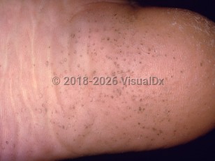 Clinical image of Pitted keratolysis - imageId=230692. Click to open in gallery.  caption: 'Multiple tiny keratin pits on the heel.'