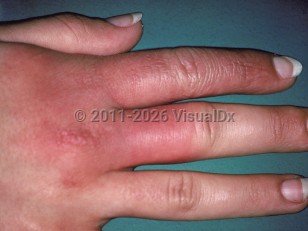 Clinical image of Erysipeloid - imageId=230835. Click to open in gallery.  caption: 'An edematous, erythematous plaque on the dorsal hand and fingers.'