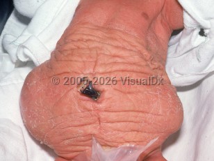 Clinical image of Prune belly syndrome - imageId=2362444. Click to open in gallery.  caption: 'A protruding abdomen with furrowing and wrinkling.'