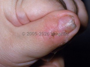 Clinical image of Lesch-Nyhan syndrome - imageId=2363526. Click to open in gallery.  caption: 'A crusted erosion atop a pink plaque at the proximal nail fold and onychodystrophy (both self-induced).'