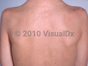 Clinical image of Cockayne syndrome - imageId=2364303. Click to open in gallery.  caption: 'Prematurely photoaged skin on the back.'
