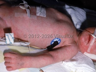 Clinical image of Argininosuccinic aciduria - imageId=2376924. Click to open in gallery.  caption: 'Widespread lacy erythematous patches on the trunk, face, and arm.'