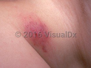Clinical image of Chronic myeloid leukemia - imageId=2388444. Click to open in gallery.  caption: 'A close-up of a purpuric plaque with a central hemorrhagic papule.'