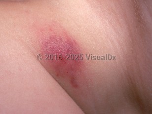 Clinical image of Chronic myeloid leukemia - imageId=2388444. Click to open in gallery.  caption: 'A close-up of a purpuric plaque with a central hemorrhagic papule.'