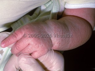 Clinical image of Severe combined immunodeficiency - imageId=2406656. Click to open in gallery.  caption: 'Diffuse pink papules and plaques on the arm of an infant with the X-linked form SCID.'