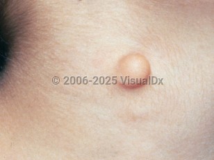 Clinical image of Cutaneous cartilaginous rest - imageId=2408736. Click to open in gallery.  caption: 'A close-up of a smooth yellowish nodule.'