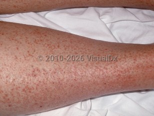 Clinical image of Hypereosinophilic syndrome - imageId=241116. Click to open in gallery.  caption: 'Widespread scaly erythematous papules (eczema) on the leg.'