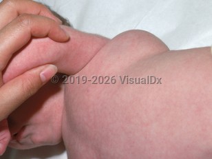 Clinical image of Cystic hygroma - imageId=2438755. Click to open in gallery.  caption: 'A smooth skin-colored subcutaneous mass near the axilla.'