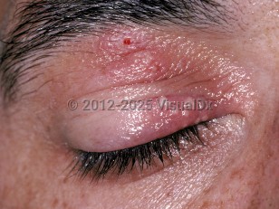 Herpes simplex virus blepharitis