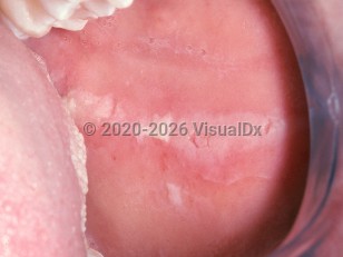 Clinical image of Contact stomatitis - imageId=2498881. Click to open in gallery.  caption: 'An elongated white plaque on the buccal mucosa and a white keratotic plaque on the lateral tongue (cinnamon reaction).'