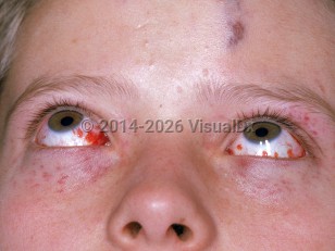 Clinical image of Bacterial meningitis - imageId=2523135. Click to open in gallery. 