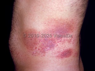 Clinical image of Poikiloderma vasculare atrophicans - imageId=2528576. Click to open in gallery.  caption: 'A broad poikilodermatous plaque with white atrophic &nbsp;and violaceous scaly portions on the flank.'