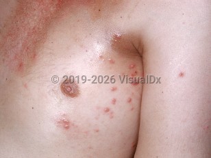 Clinical image of Hodgkin lymphoma - imageId=2531006. Click to open in gallery.  caption: 'Many smooth light pink and somewhat grayish papules on the chest and a similar crusted papule on the arm.'