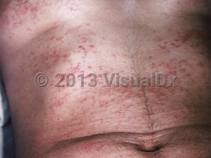 Clinical image of Seabather's eruption - imageId=253952. Click to open in gallery.  caption: 'Myriads of erythematous papules on the trunk (areas that were beneath a bathing suit).'