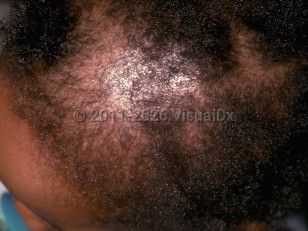 Clinical image of Drug-induced alopecia - imageId=255411. Click to open in gallery.  caption: 'Decreased hair density on the frontal scalp.'