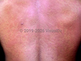 Clinical image of Human immunodeficiency virus primary infection - imageId=2583139. Click to open in gallery.  caption: 'Widespread erythematous papules and plaques on the back.'