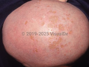 Clinical image of Delusions of parasitosis - imageId=2707064. Click to open in gallery. 