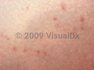 Clinical image of Enteric fever - imageId=2721479. Click to open in gallery.  caption: 'A close-up of tiny erythematous macules and thin papules ("rose spots").'
