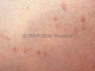 Enteric fever