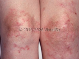 Clinical image of Polyarteritis nodosa - imageId=2732508. Click to open in gallery.  caption: 'Retiform, erythematous plaques with central brown patches on the knees.'